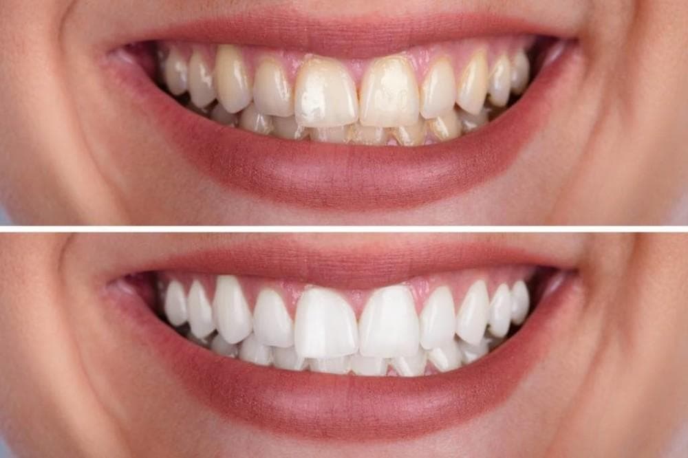 Teeth Whitening / Brightening in Valsad