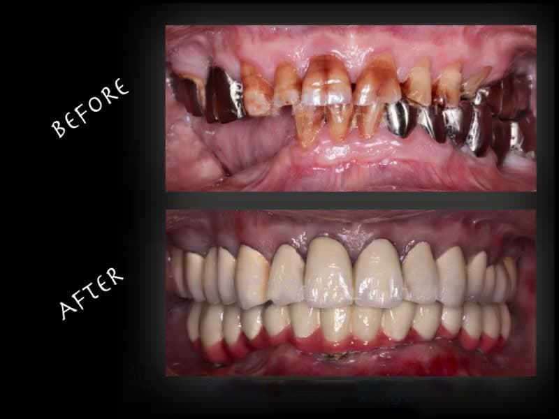 MOTTLING TEETH CORRECTION