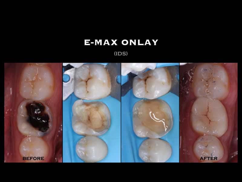 Ceramic Inlay & Onlay