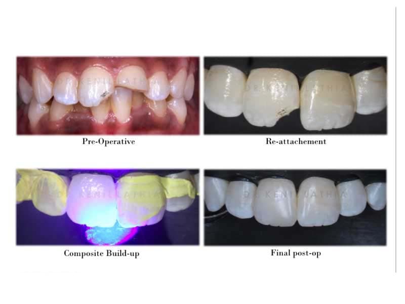 Cosmetic tooth colored filling