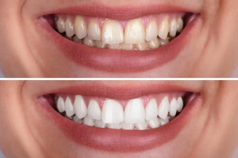 Teeth Whitening / Brightening in San Diego Teeth Whitening / Brightening-in-San Diego